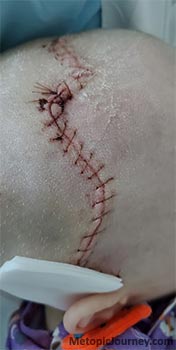 Scar Metopic Craniosynostosis