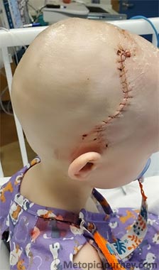Metopic Craniosynostosis Operation