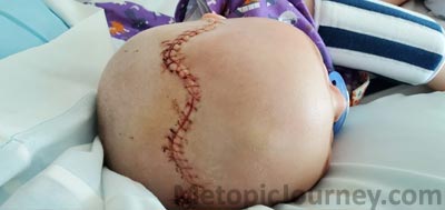 Metopic Craniosynostosis Scar