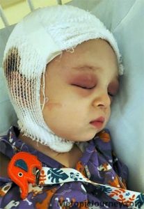 Metopic Craniosynostosis Close Up