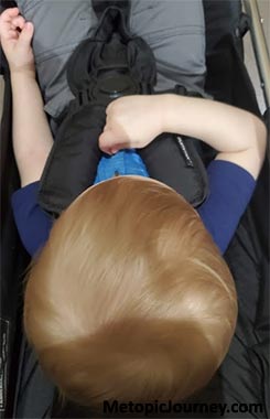 Head Narrowing Metopic Craniosynostosis Trigonocephaly