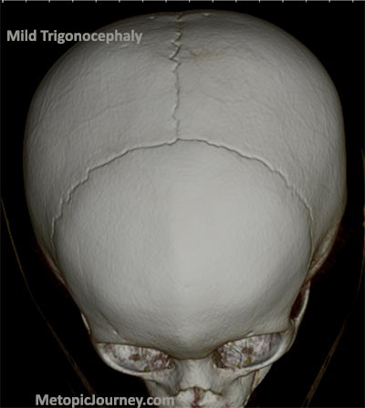 Mild Metopic Craniosynostosis Trigonocephaly