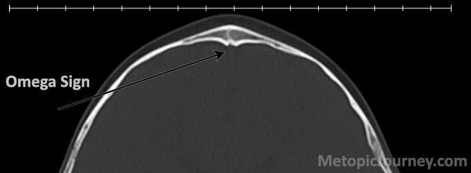 Omega Sign Head Metopic Craniosynostosis Trigonocephaly