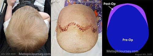 Metopic Craniosynostosis Before and After